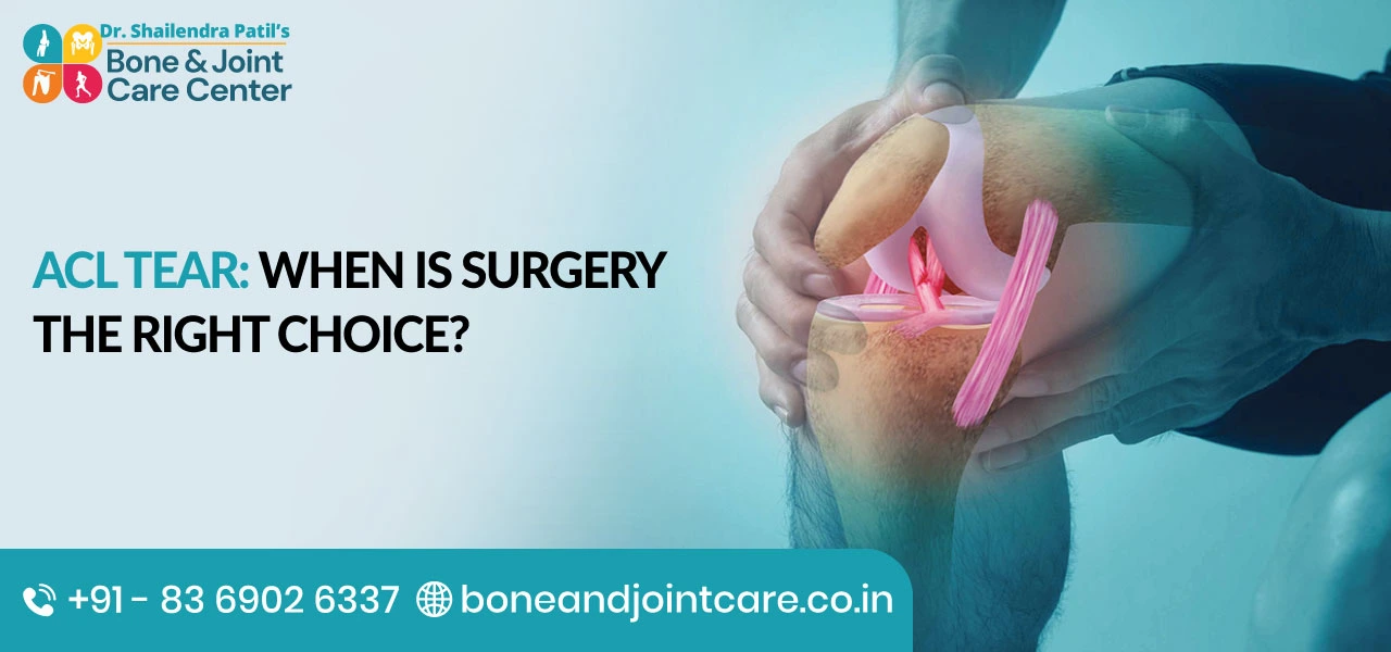 ACL Tear: When Is Surgery the Right Choice?