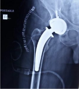 x-ray-Hip-replacement-267x300