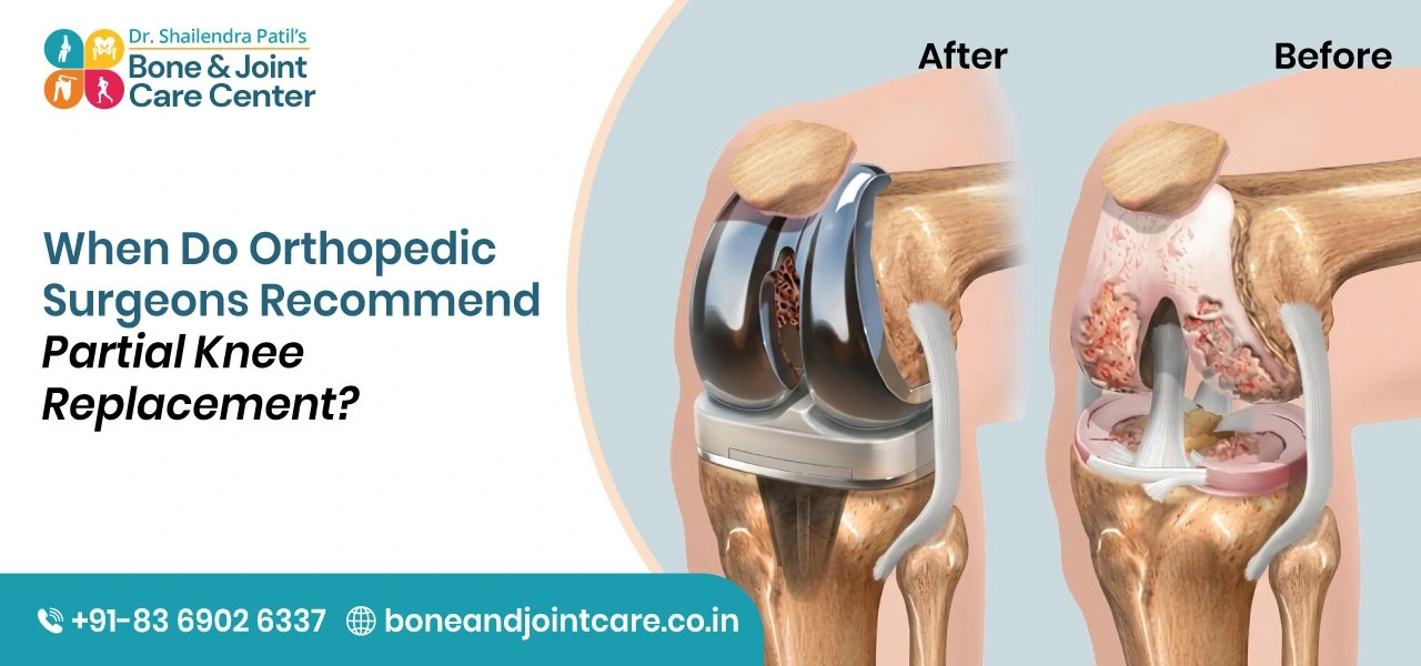 When Do Orthopedic Surgeons Recommend Partial Knee Replacement?