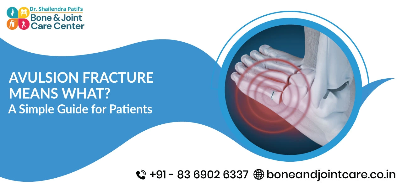 Avulsion Fracture Means What? A Simple Guide for Patients
