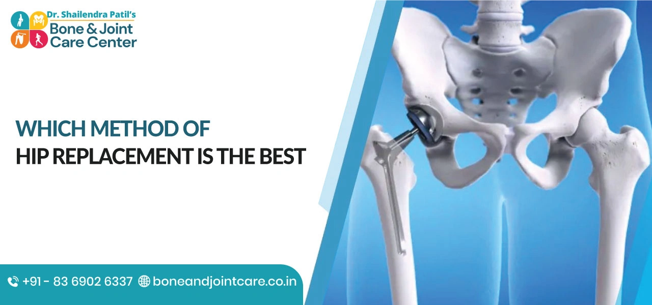 Which method of hip replacement is the best