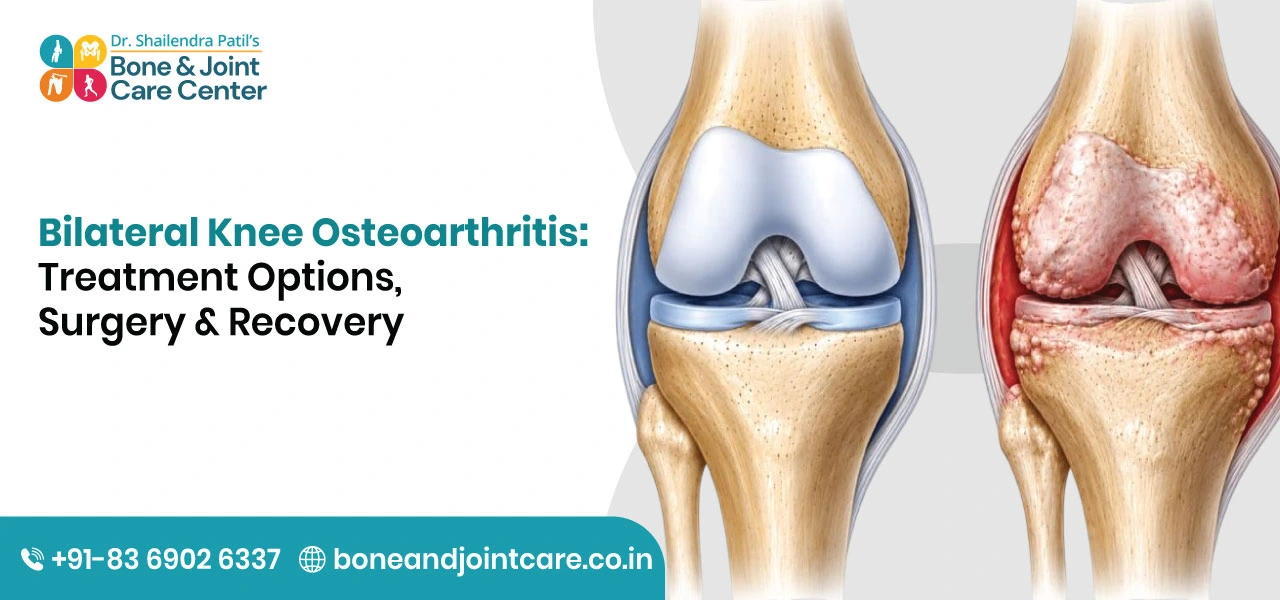 Bilateral-Knee-Osteoarthritis