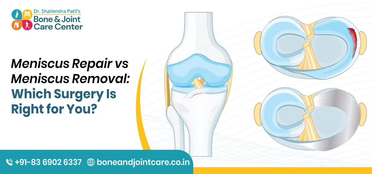 Meniscus Repair vs Meniscus Removal: Which Surgery Is Right for You?